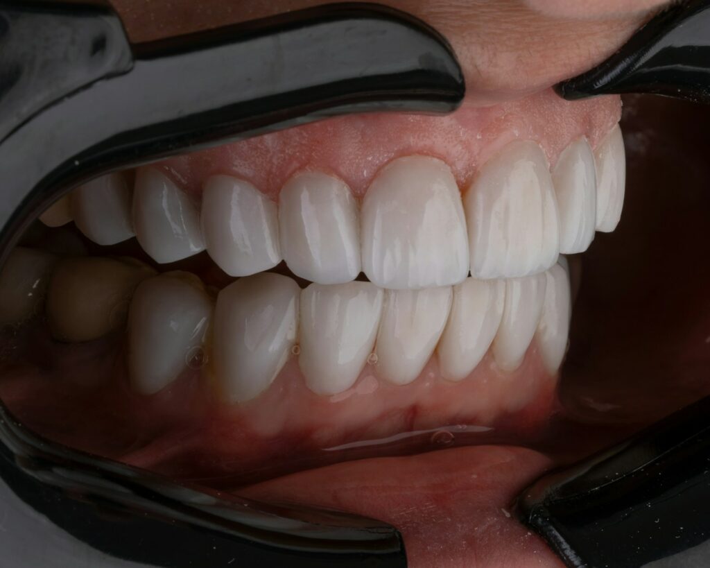 Zahnzusatzversicherung professionelle Zahnreinigung